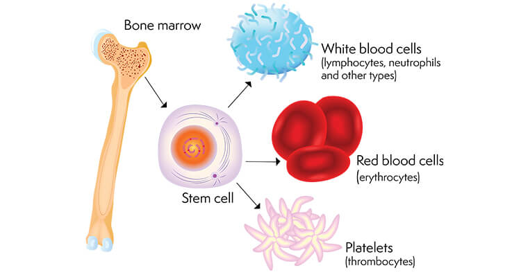 Bone marrow transplant in Hyderabad